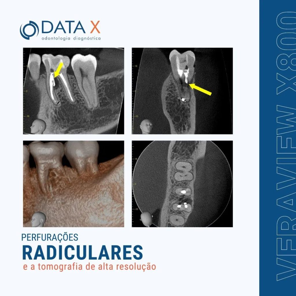 perfuracoes-radiculares