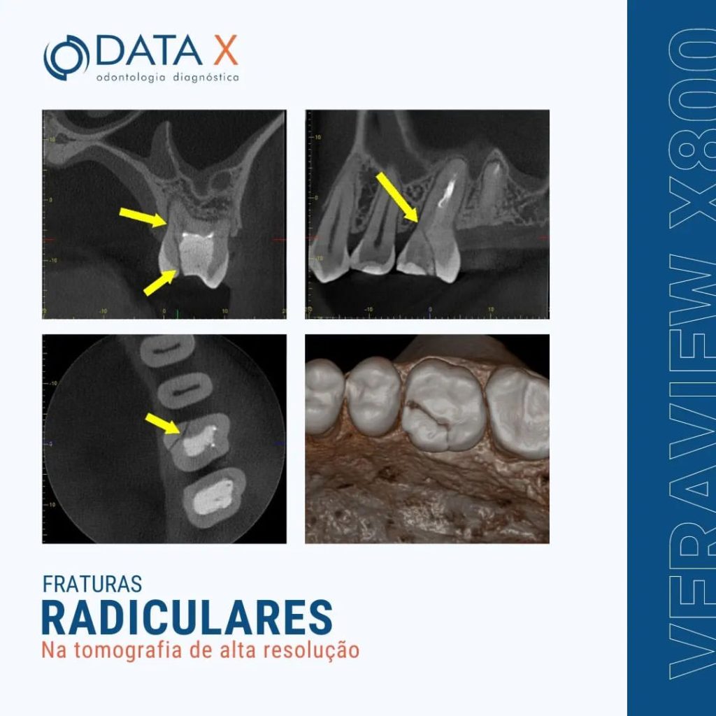 fraturas-radiculares