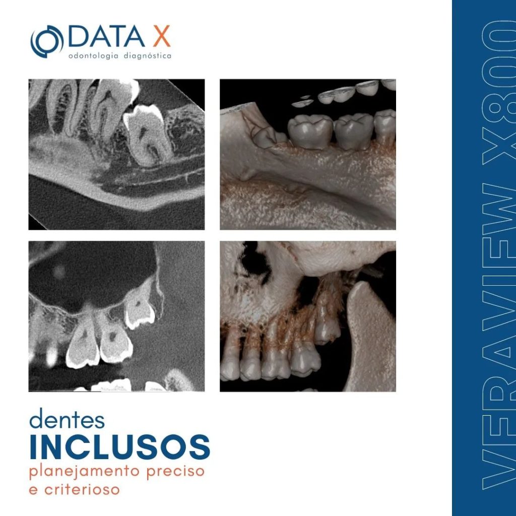 dentes-inclusos