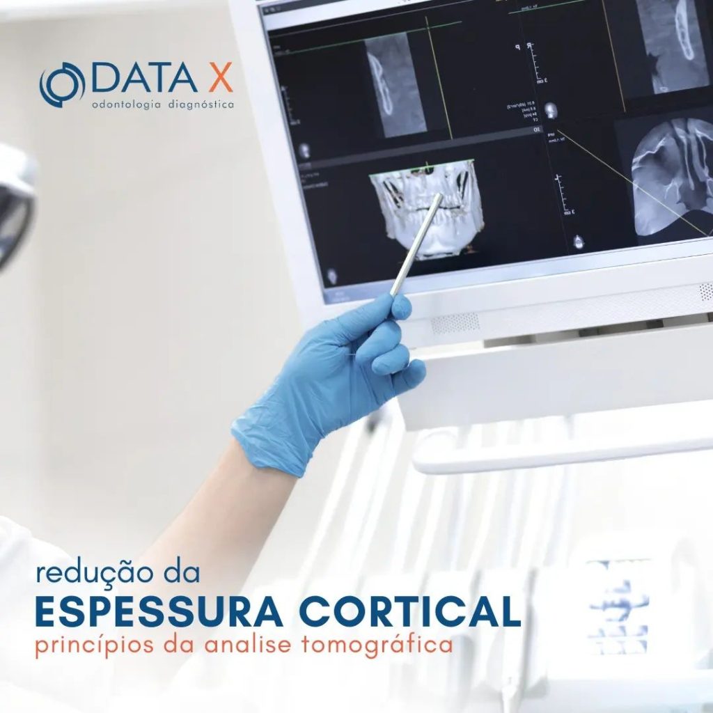 reducao-da-espessura-cortical