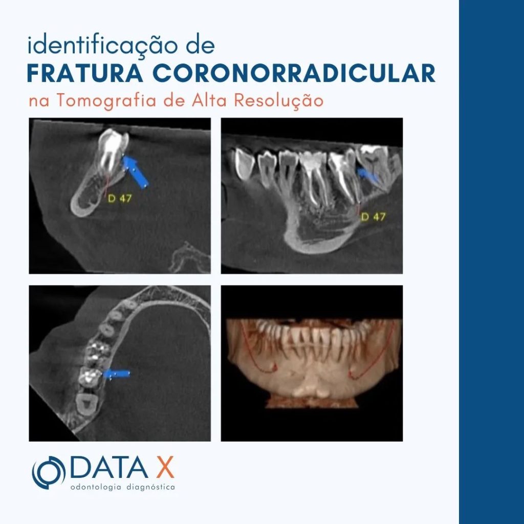 identificacao-de-fratura-coronorradicular