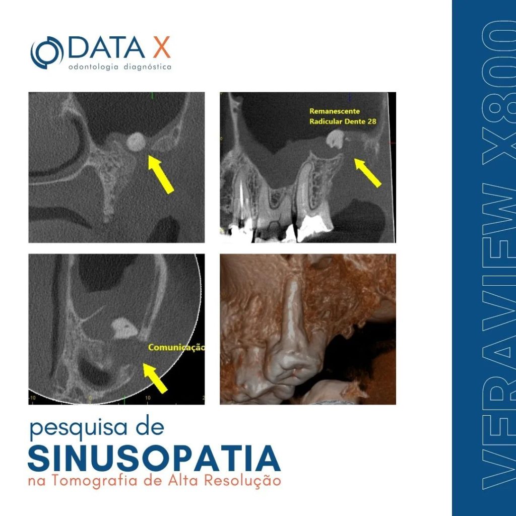 pesquisa-de-sinusopatia