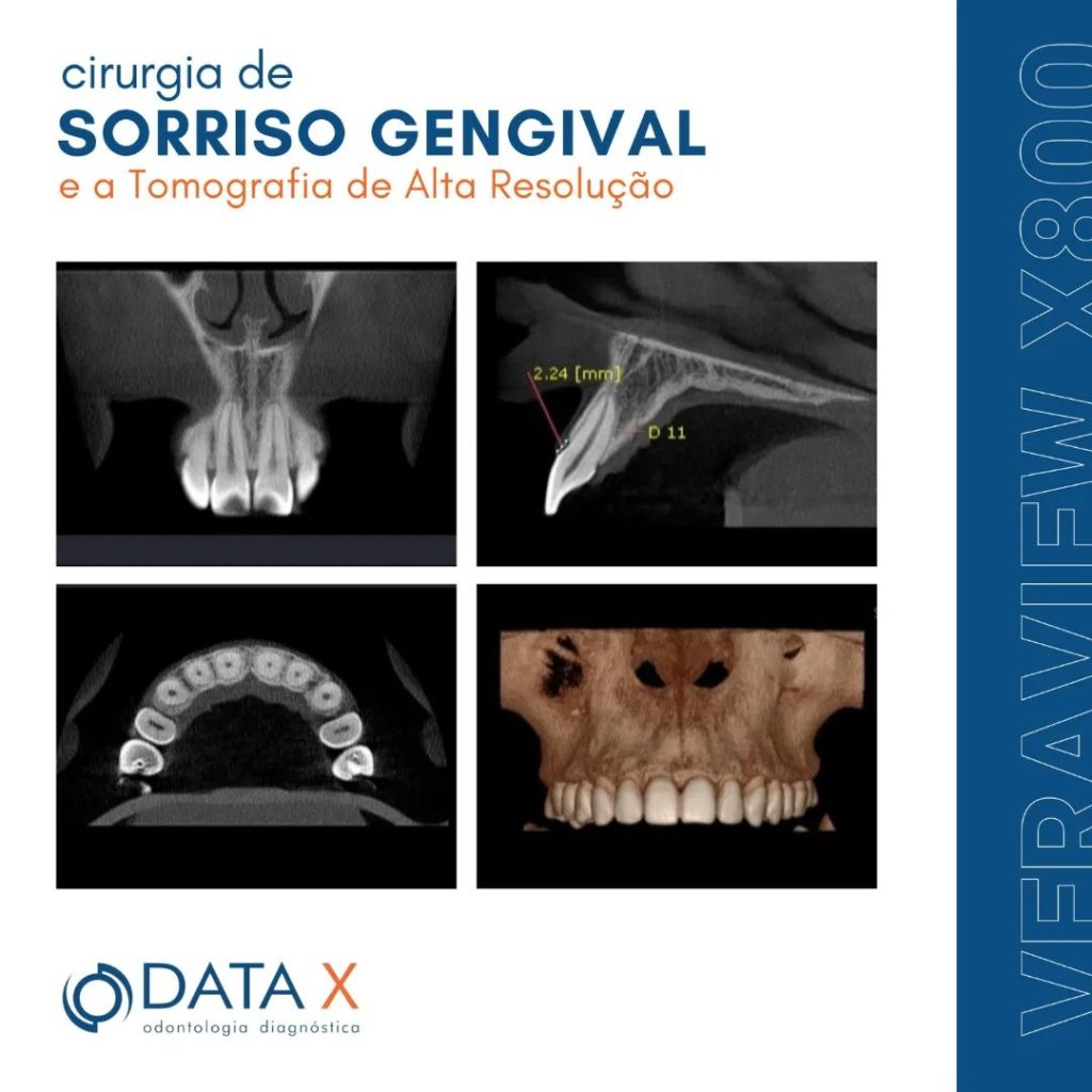 cirurgia-de-sorriso-gengival