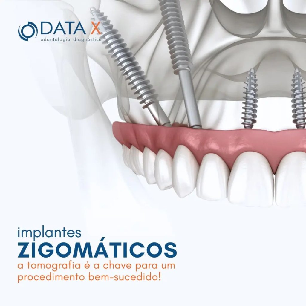 implantes-zigomaticos