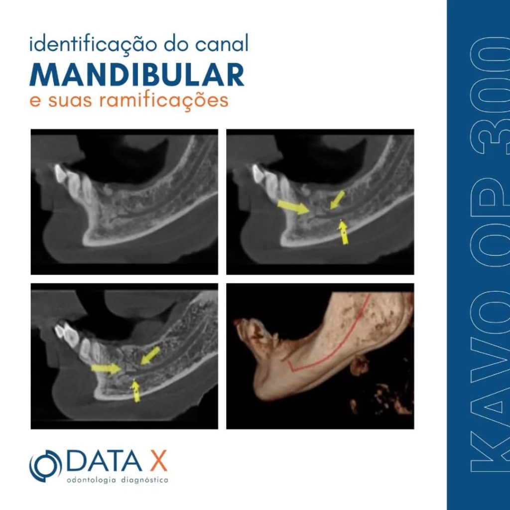 identificacao-do-canal-mandibular