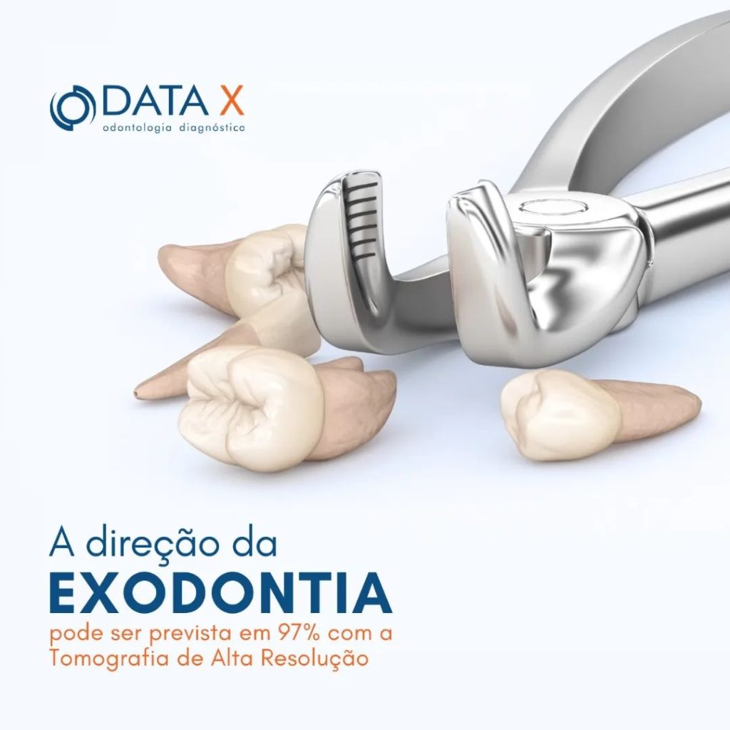 a-direcao-da-exodontia