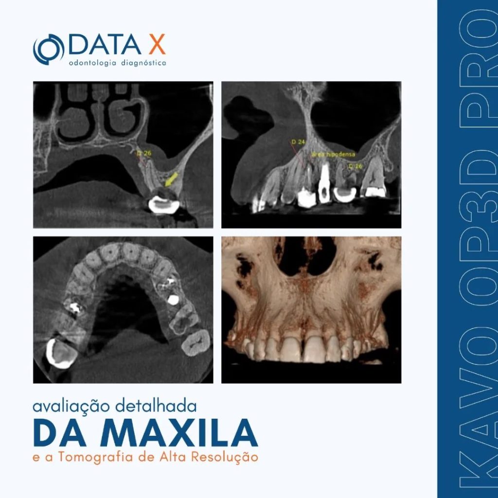 avaliacao-detalhada-da-maxila