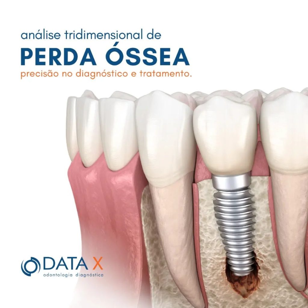 analise-tridimensional-de-perda-ossea