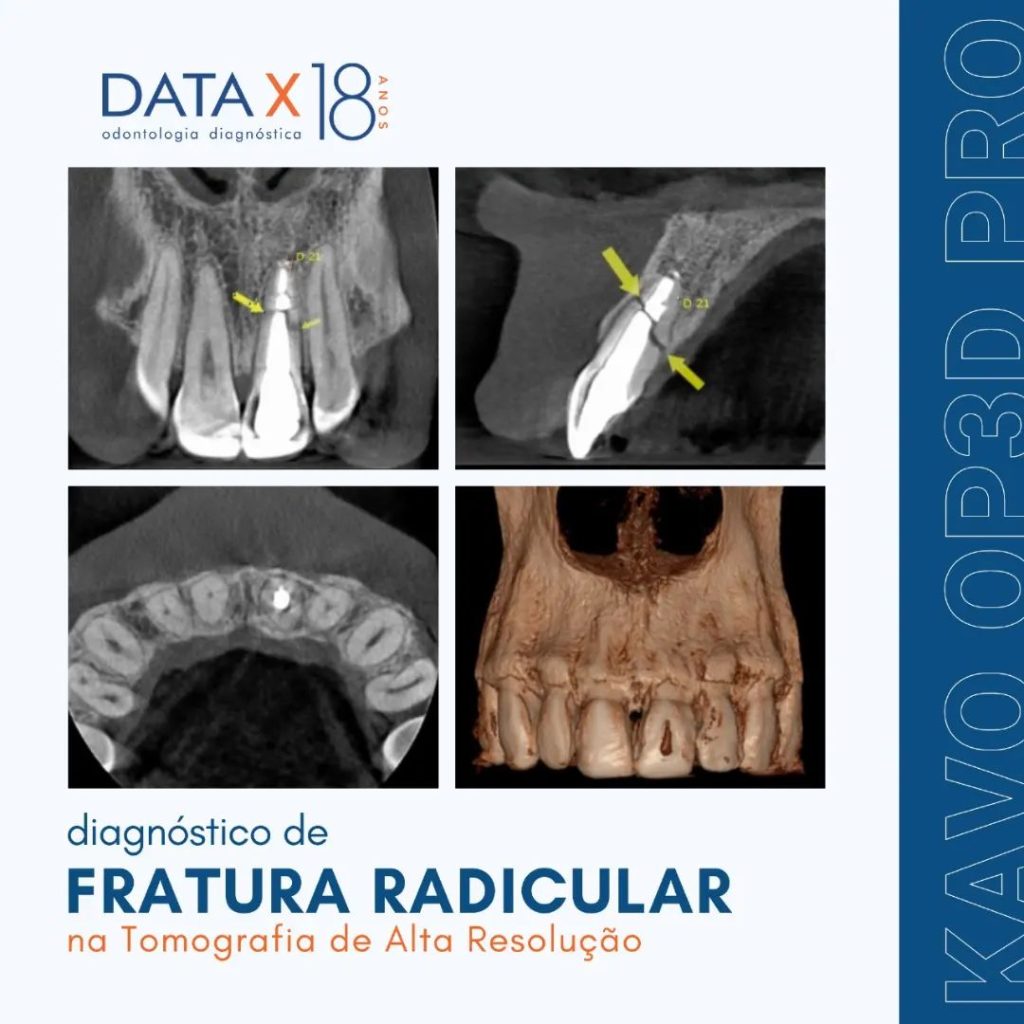 diagnostico-de-fratura-radicular