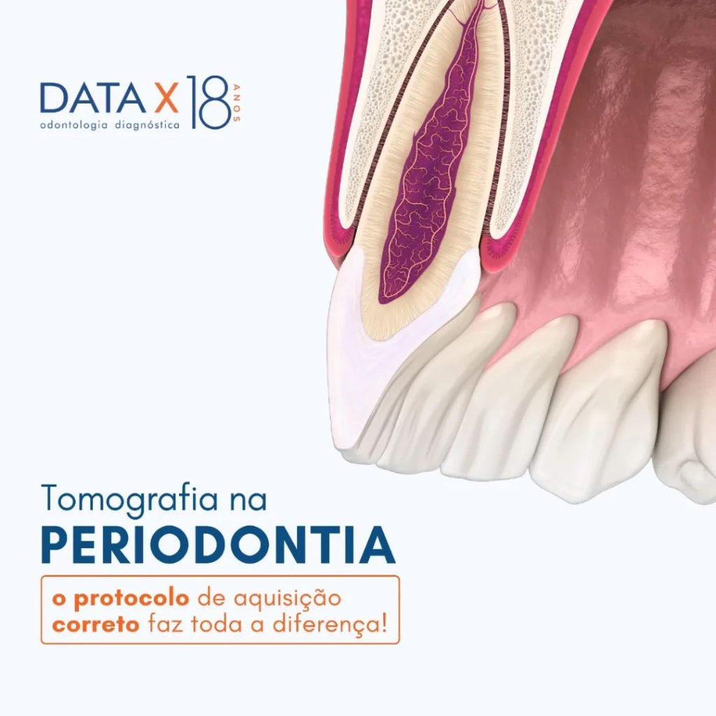 tomografia-na-periodontia