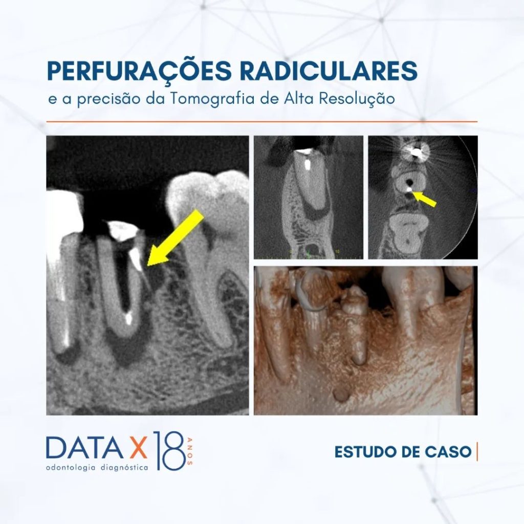 perfuracoes-radiculares