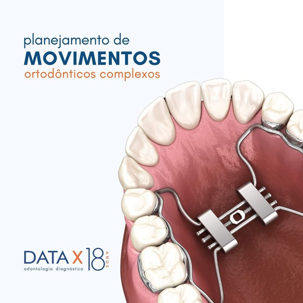 planejamento-de-movimentos-ortodonticos-complexos