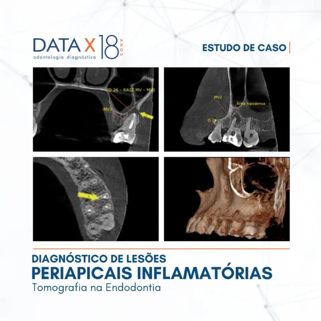 diagnostico-de-lesoes-periapicais-inflamatorias