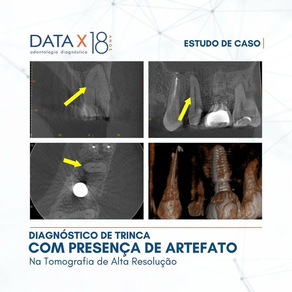 diagnostico-de-trinca-com-presenca-de-artefato