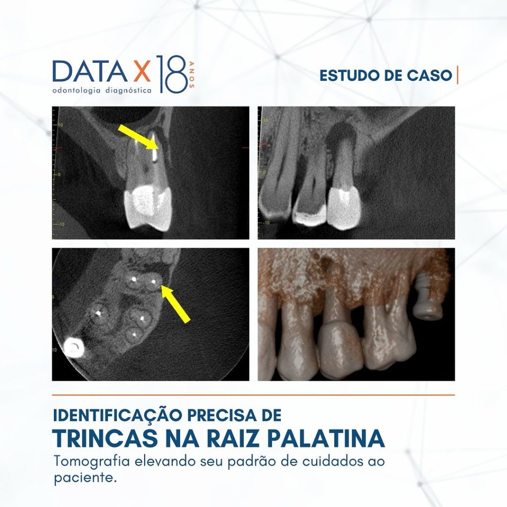 identificacao-precisa-de-trincas-na-raiz-palatina