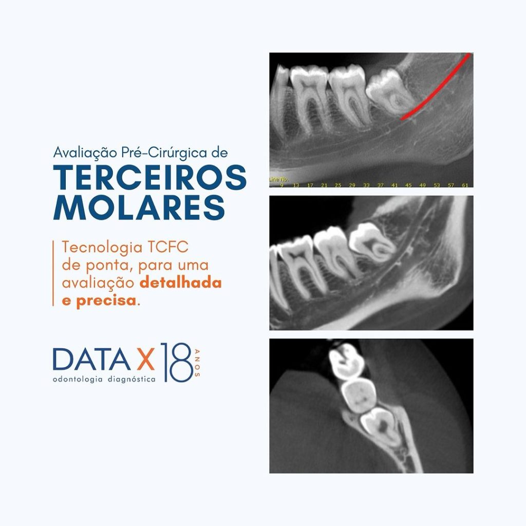 avaliacao-pre-cirurgica-de-terceiros-molares