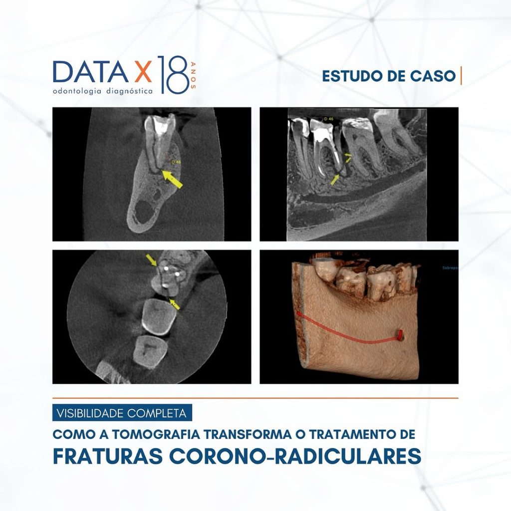 tratamento-de-fraturas-corono-radiculares