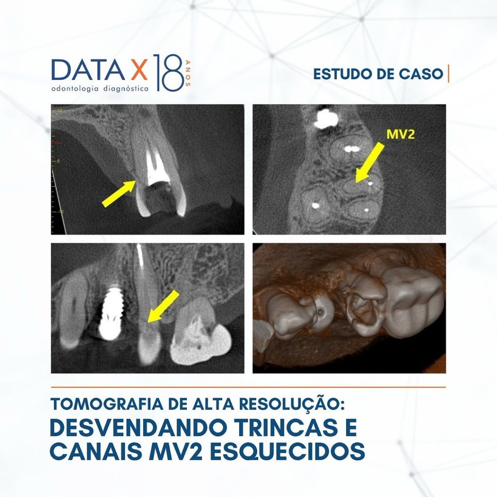 desvendando-trincas-e-canais-mv2-esquecidos