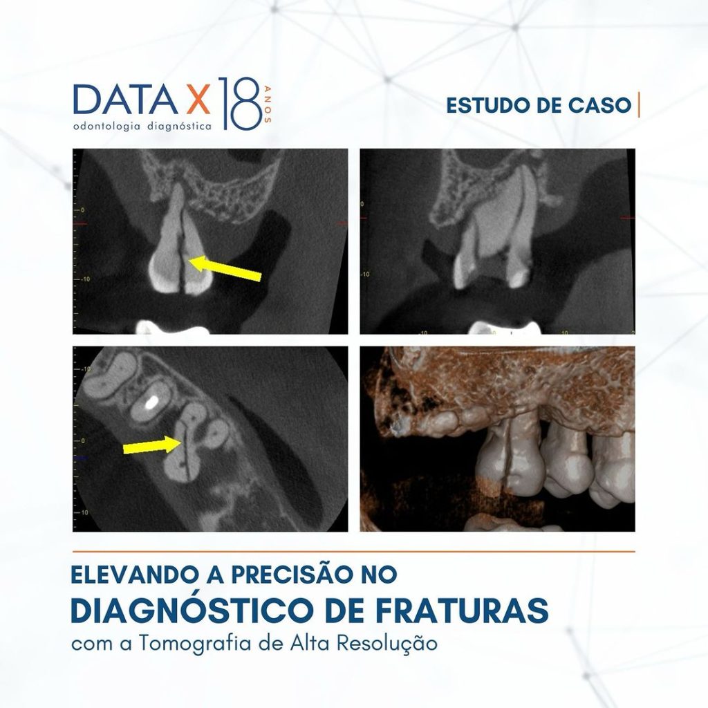 elevando-a-precisao-no-diagnostico-de-fraturas