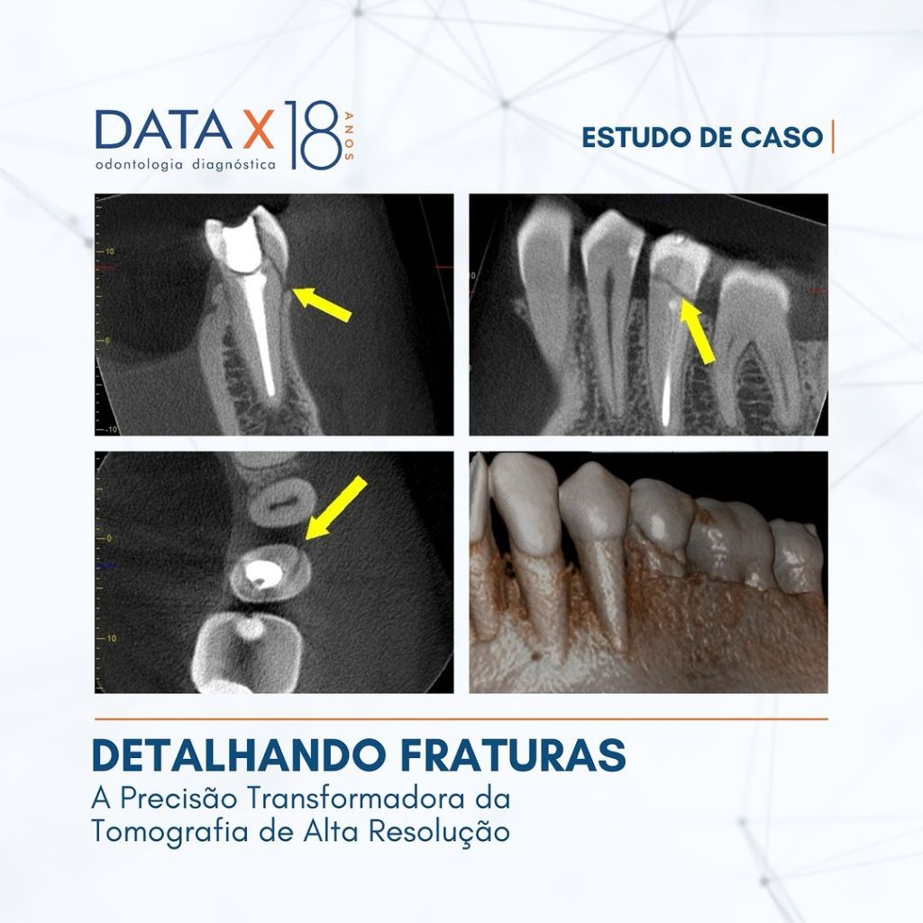 detalhando-fraturas