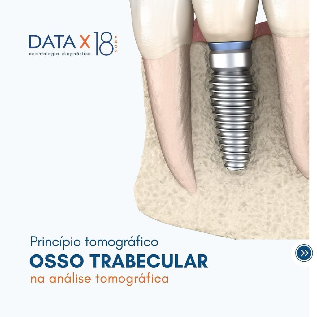 osso-trabecular