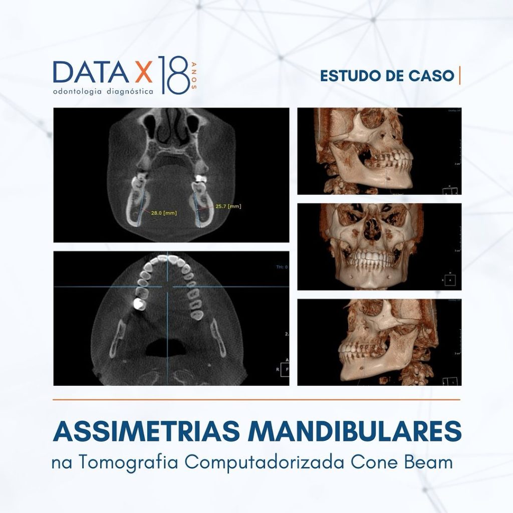 assimetrias-mandibulares