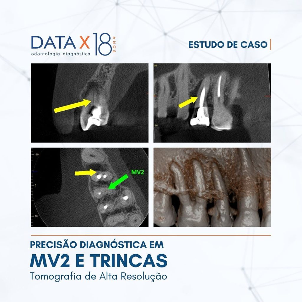 precisao-diagnostica-em-mv2-e-trincas