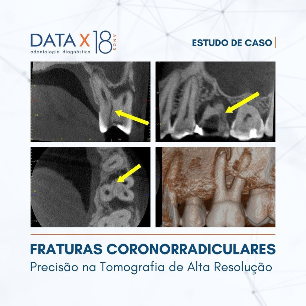 fraturas-coronorradiculares