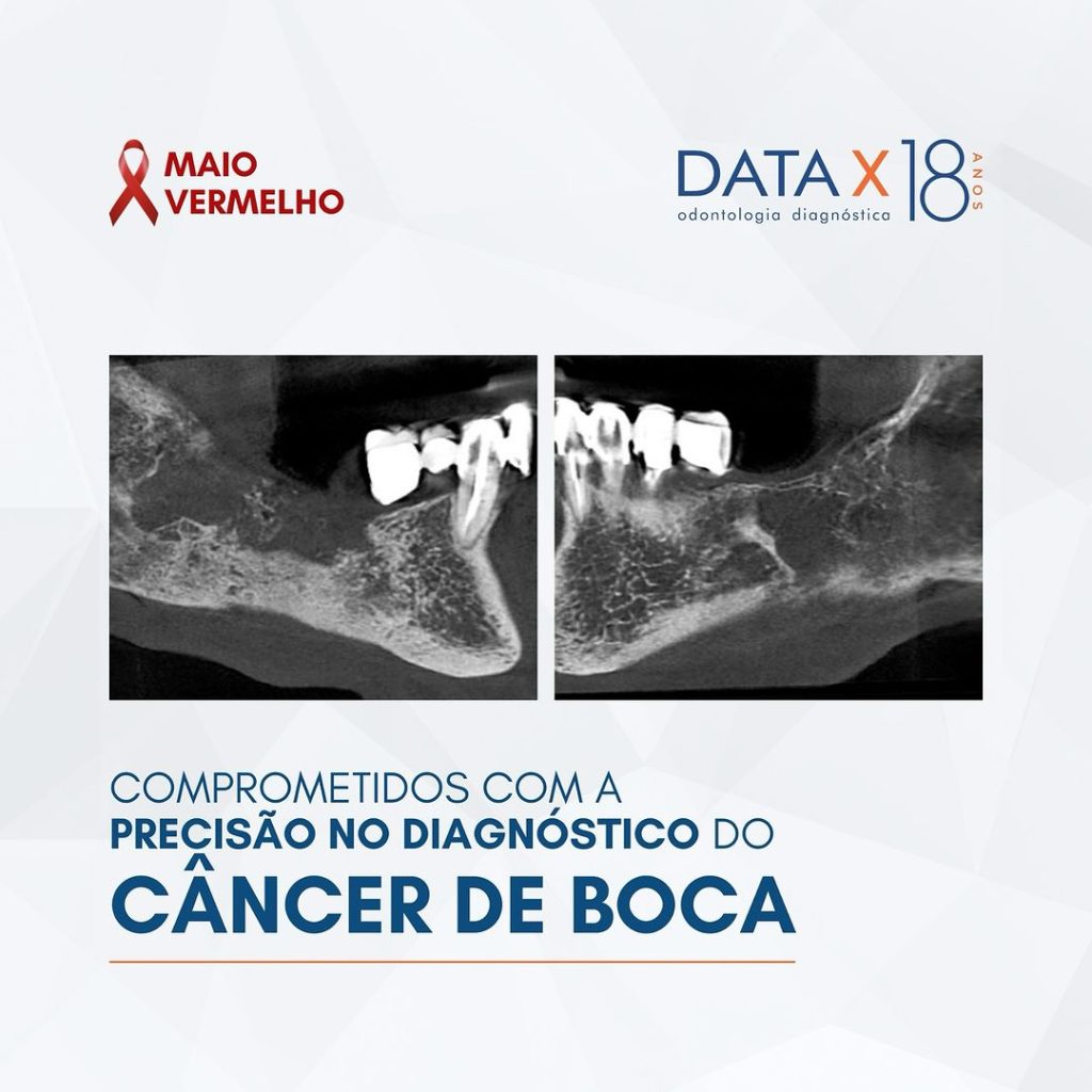 precisao-no-diagnostico-do-cancer-de-boca