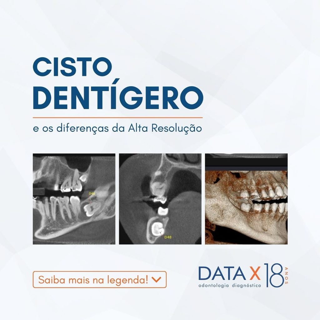 cisto-dentigero