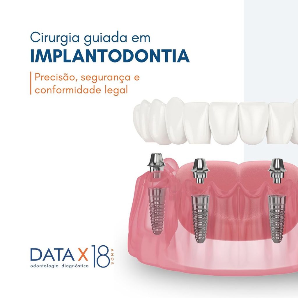 cirurgia-guiada-em-implantodontia