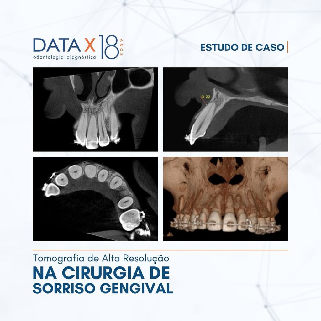 tomografia-e-a-cirurgia-de-sorriso-gengival