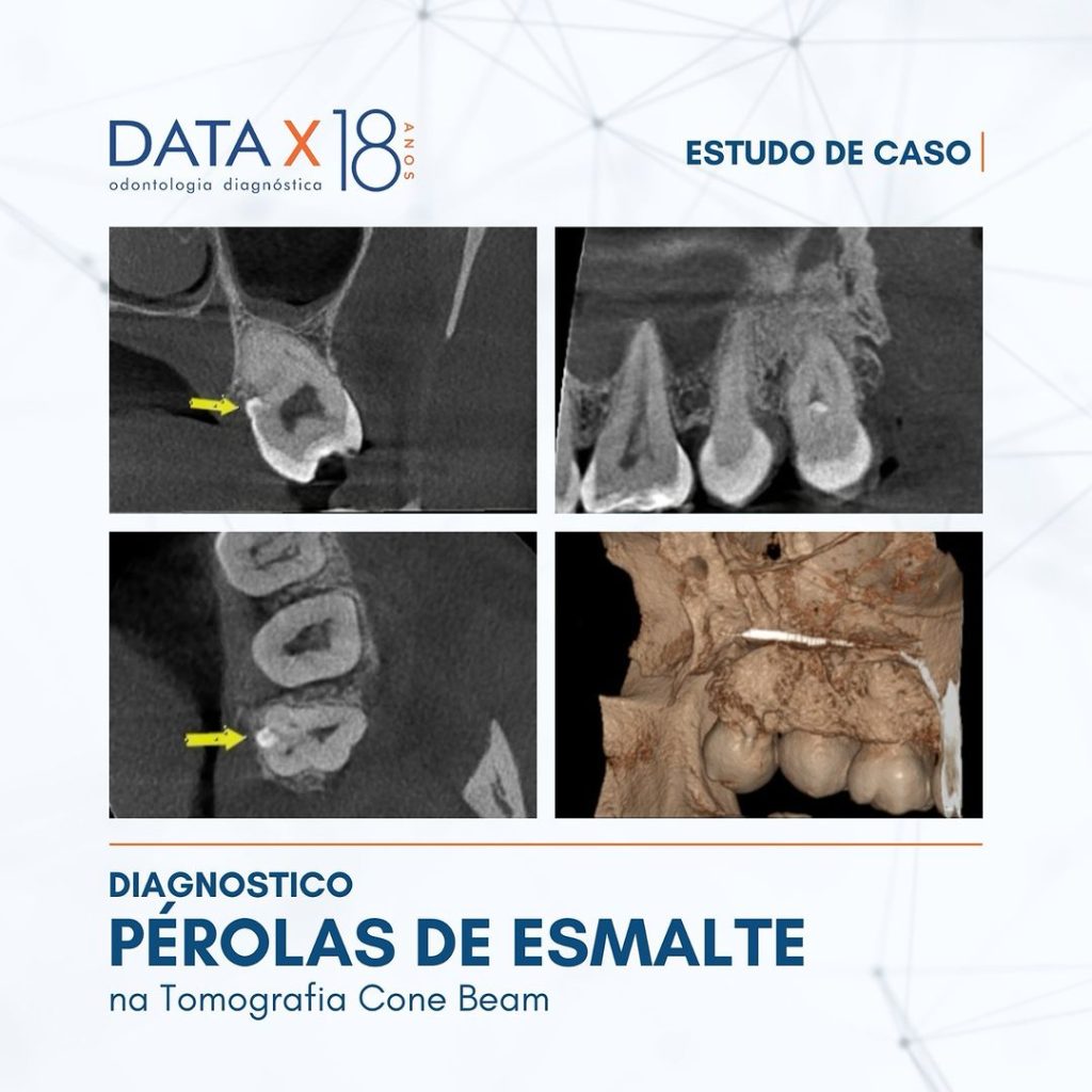 diagnostico-de-perolas-de-esmalte