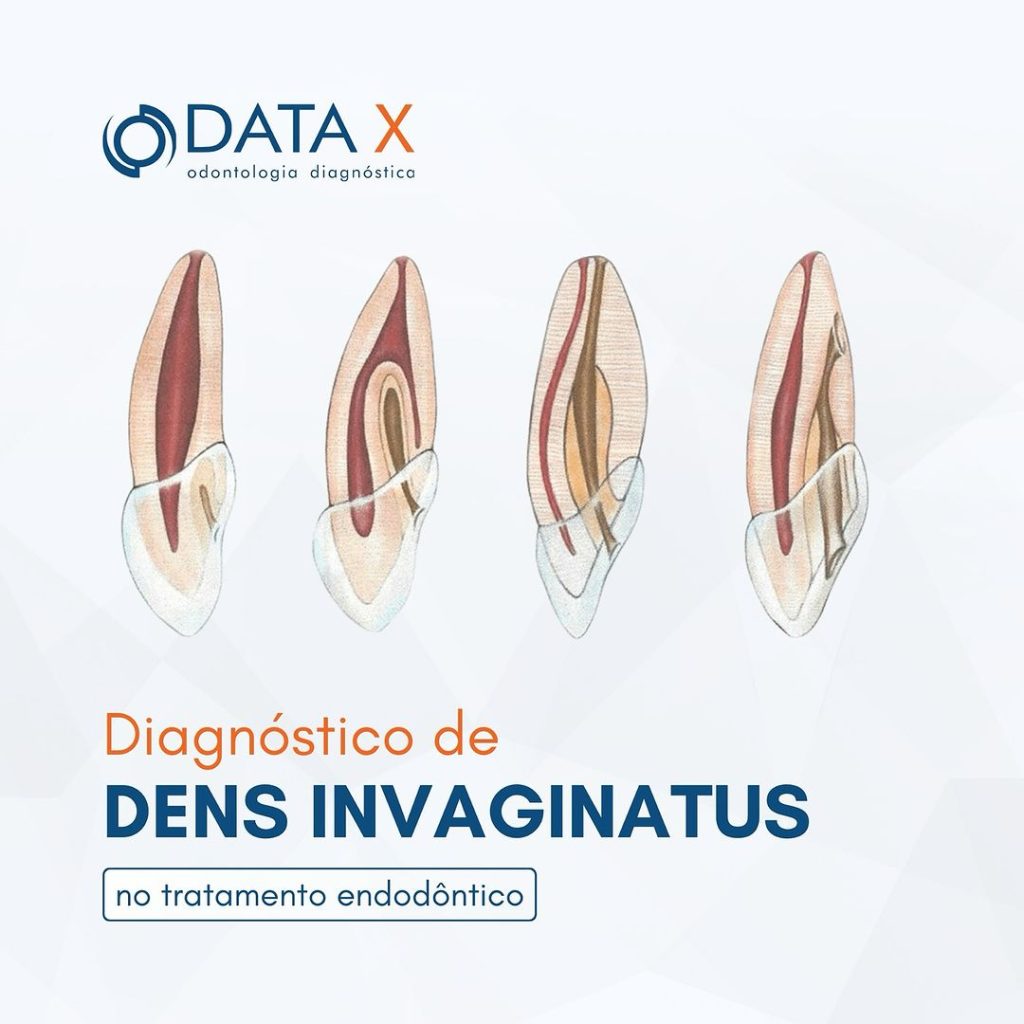 diagnostico-de-dens-invaginatus