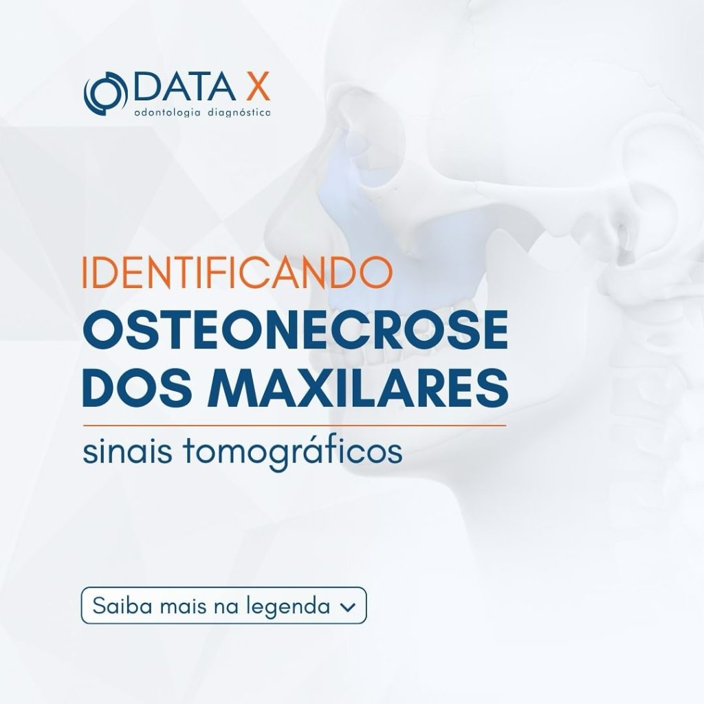 identificando-osteonecrose-dos-maxilares