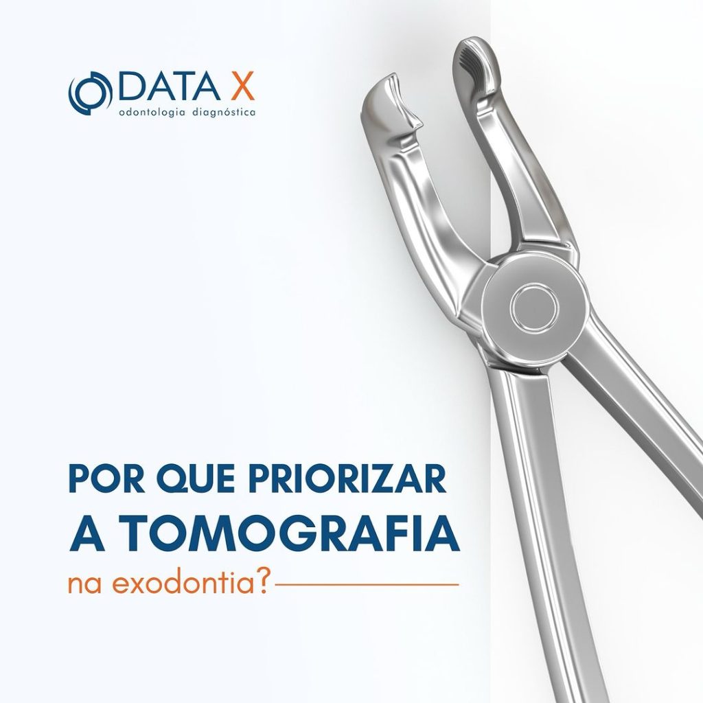 por-que-priorizar-a-tomografia-na-exodontia