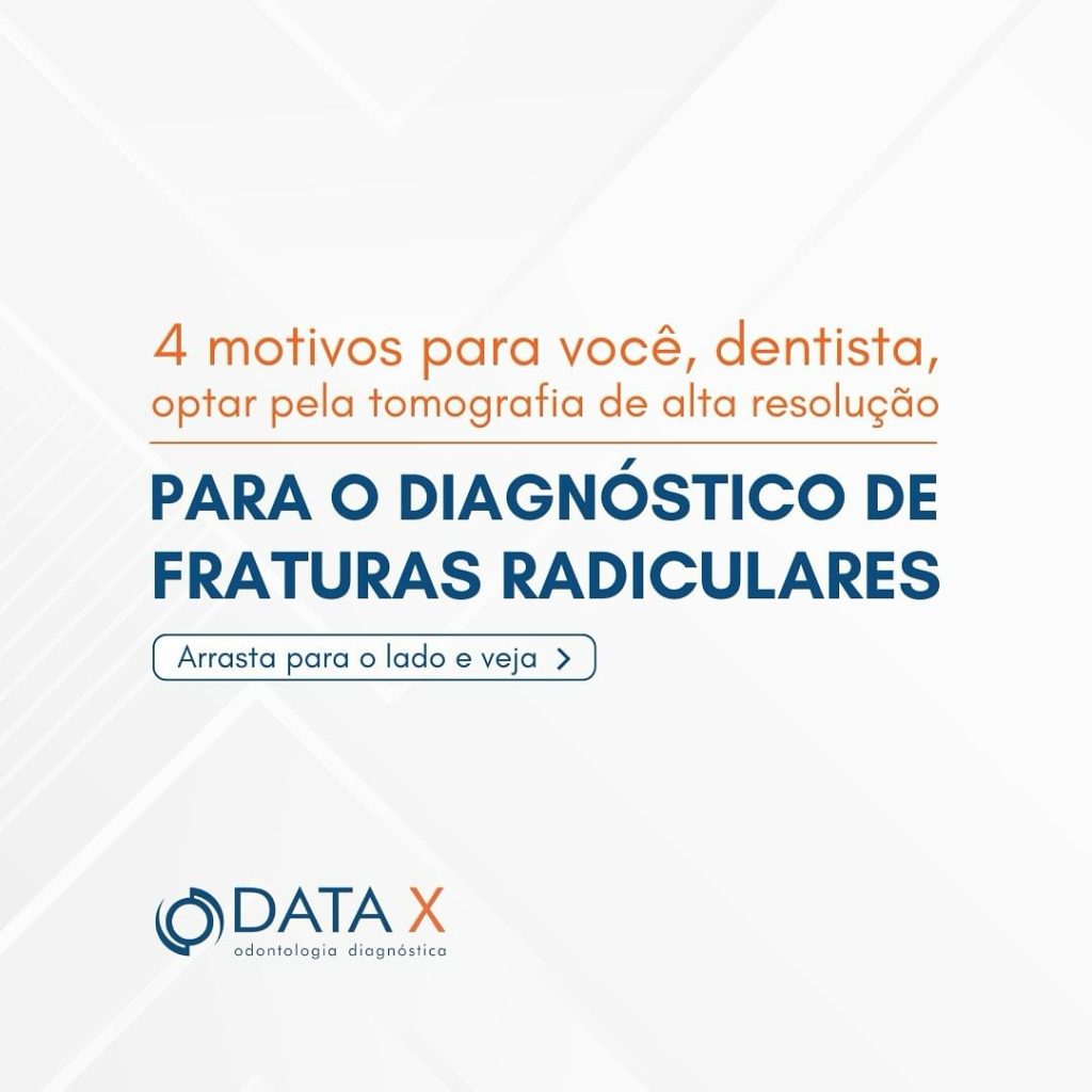 a-tomografia-no-diagnostico-de-fraturas-radiculares