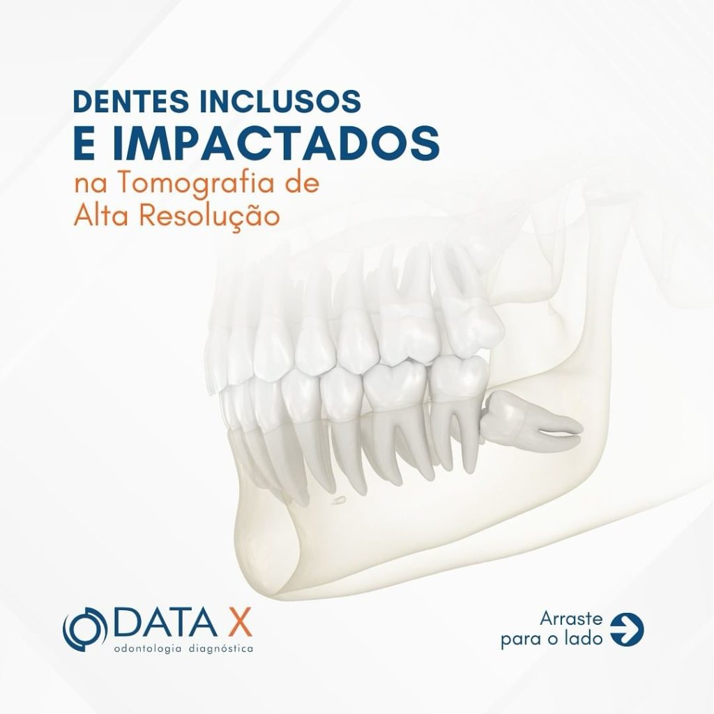 dentes-inclusos-e-impactados