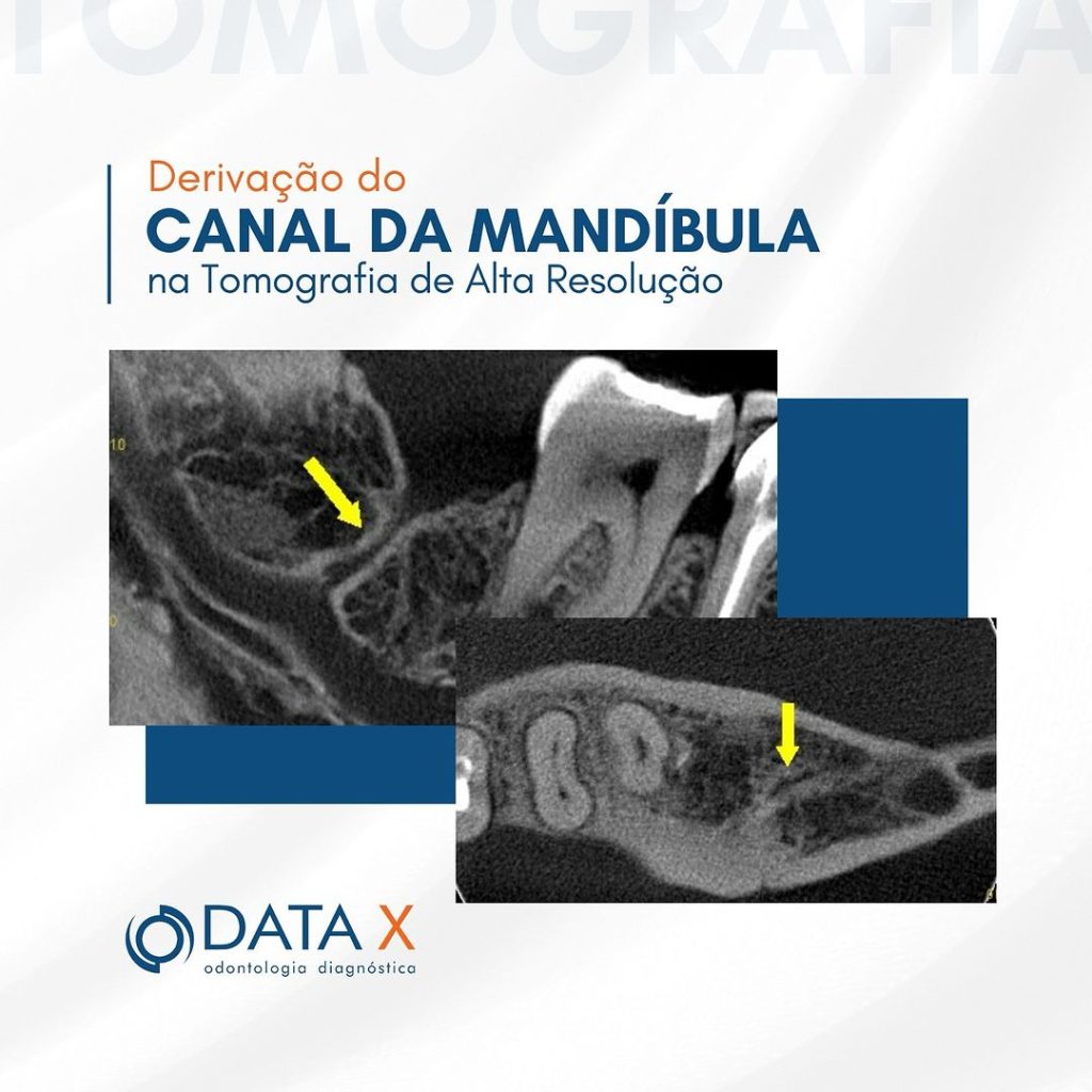 derivacao-do-canal-da-mandibula