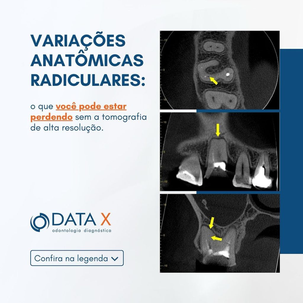 variacoes-anatomicas-radiculares