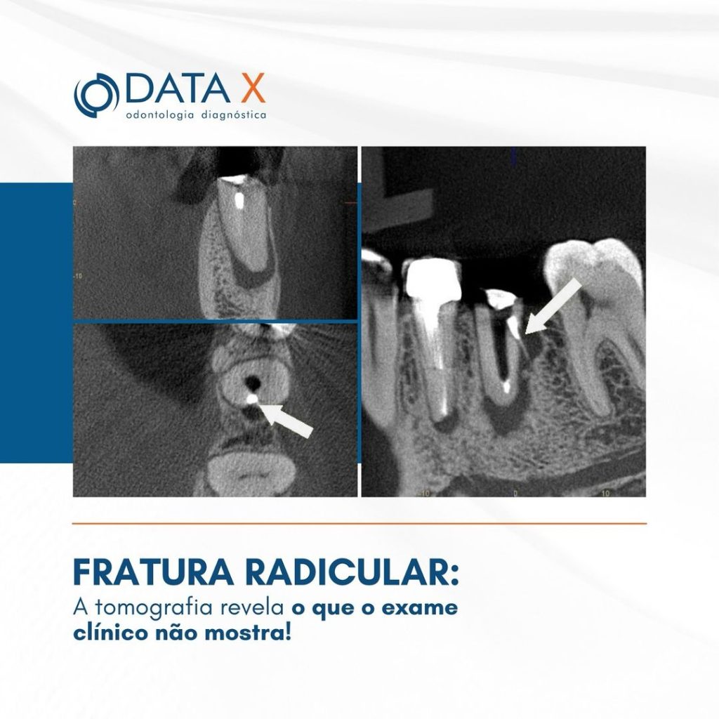 fratura-radicular