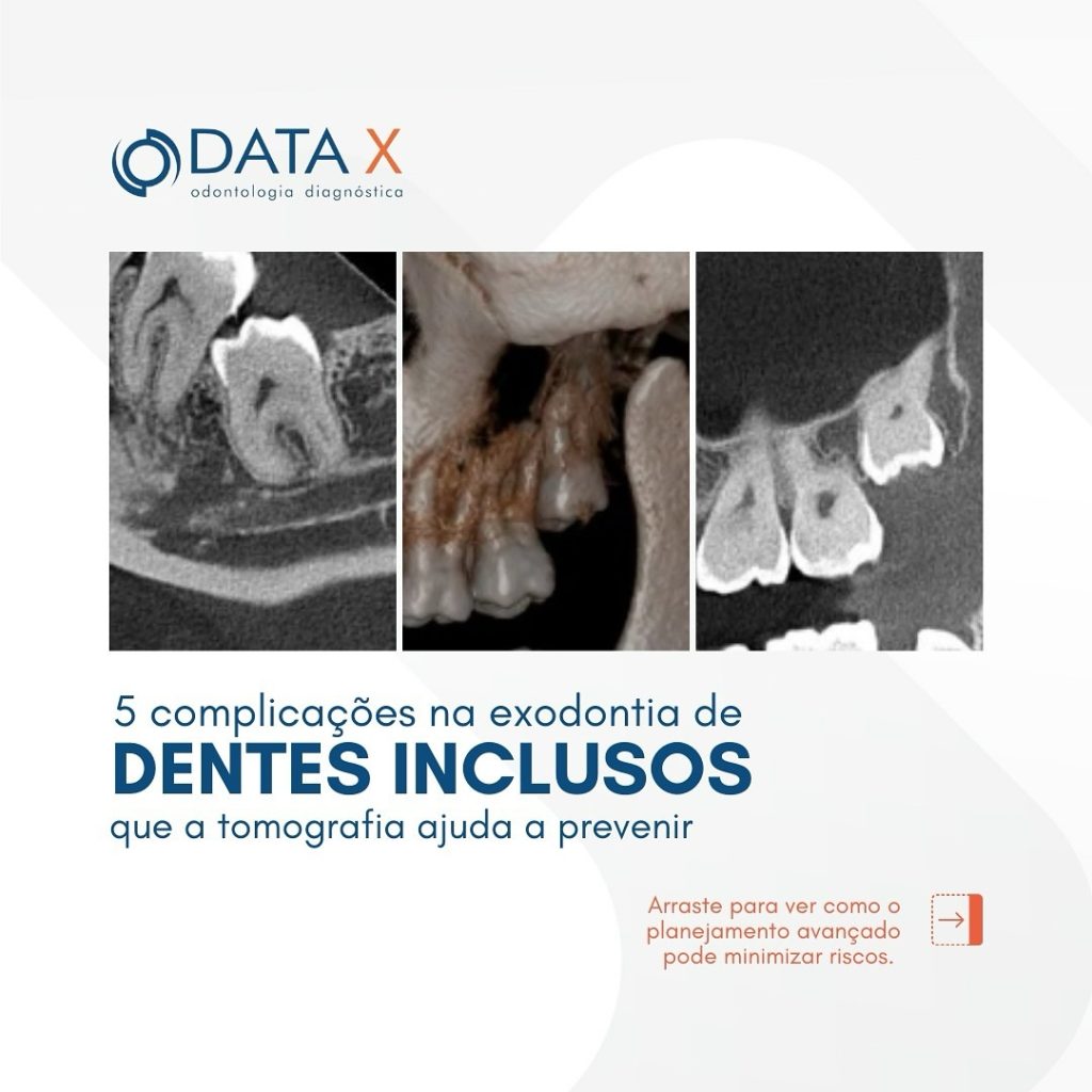 exodontia-de-dentes-inclusos