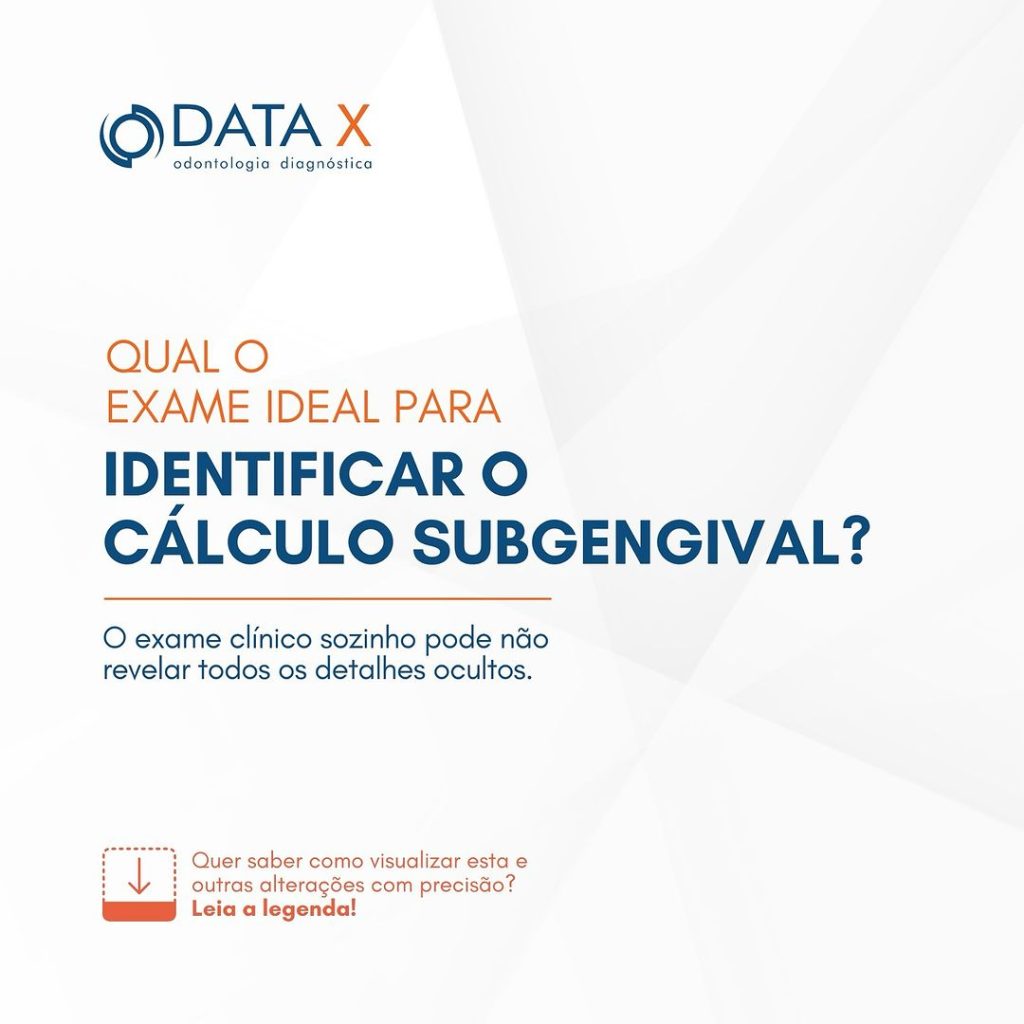 identificacao-do-calculo-subgengival