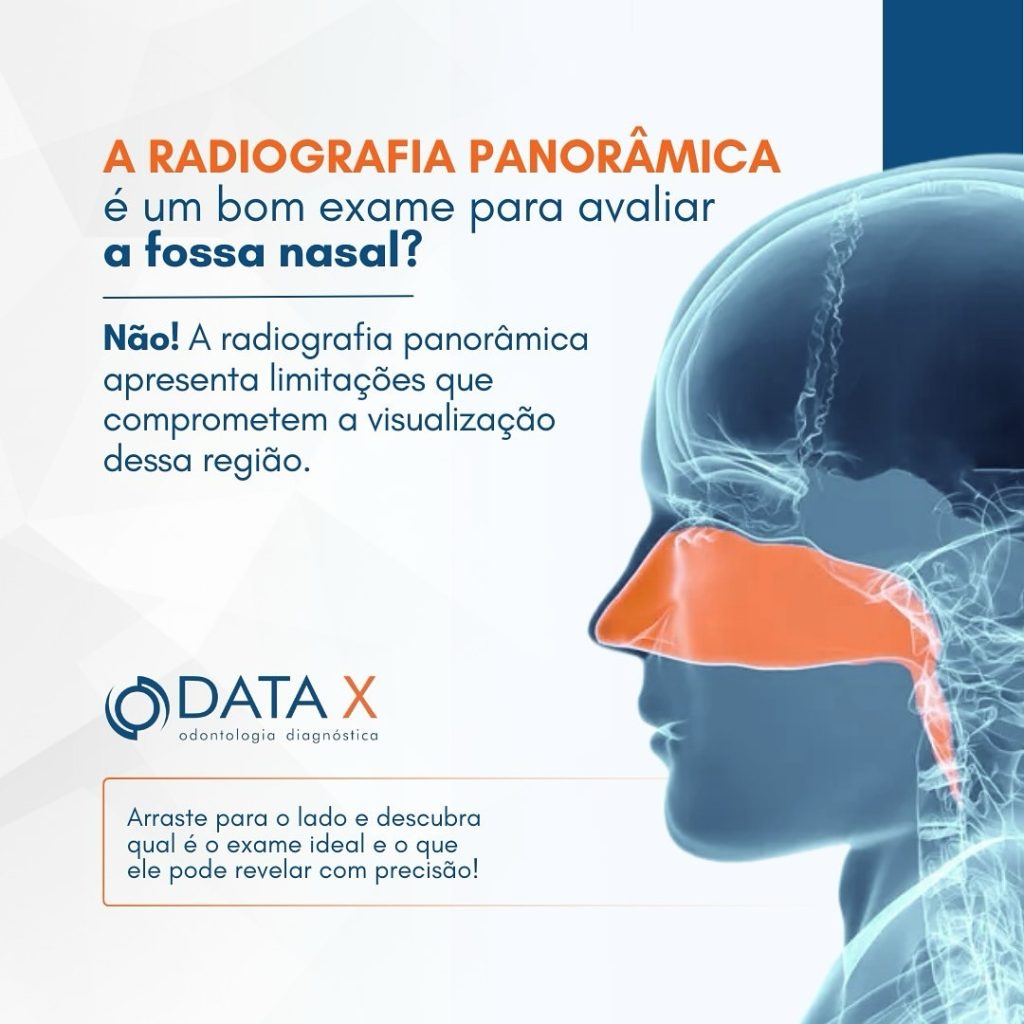 a-radiografia-panoramica-e-a-fossa-nasal