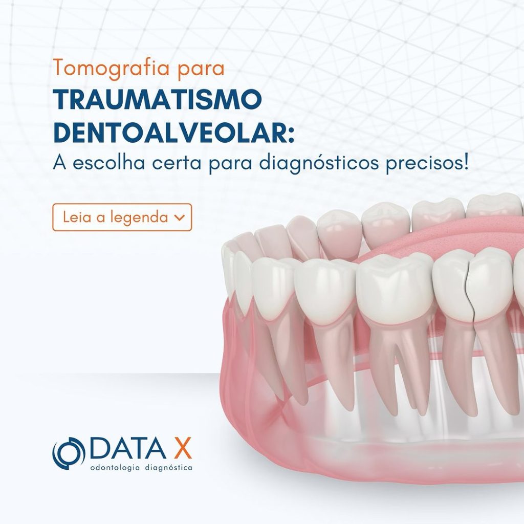 traumatismo-dentoalveolar