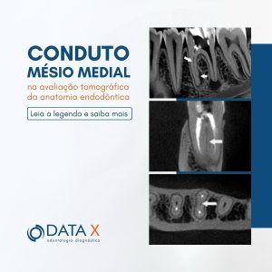 conduto-mesio-medial