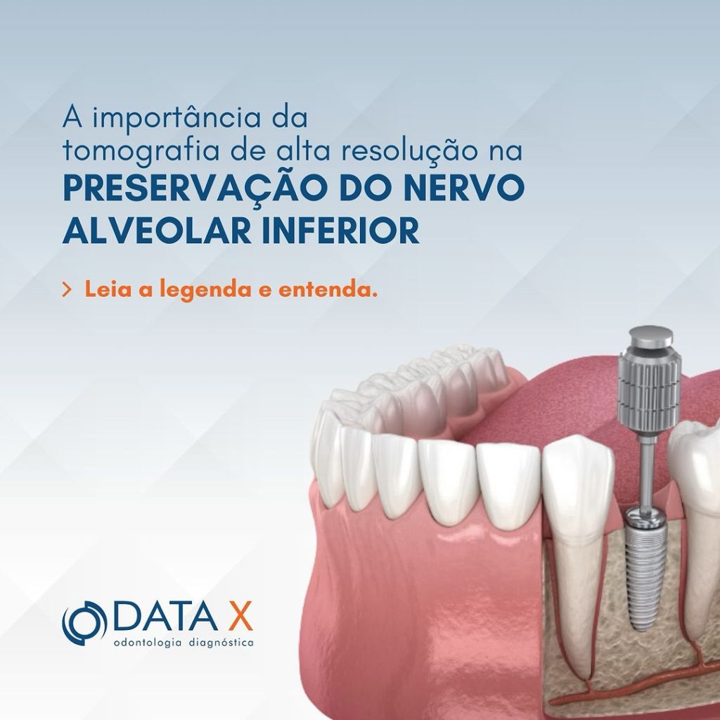 a-preservacao-do-nervo-alveolar-inferior