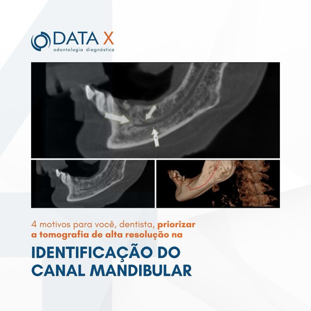 a-identificacao-do-canal-mandibular