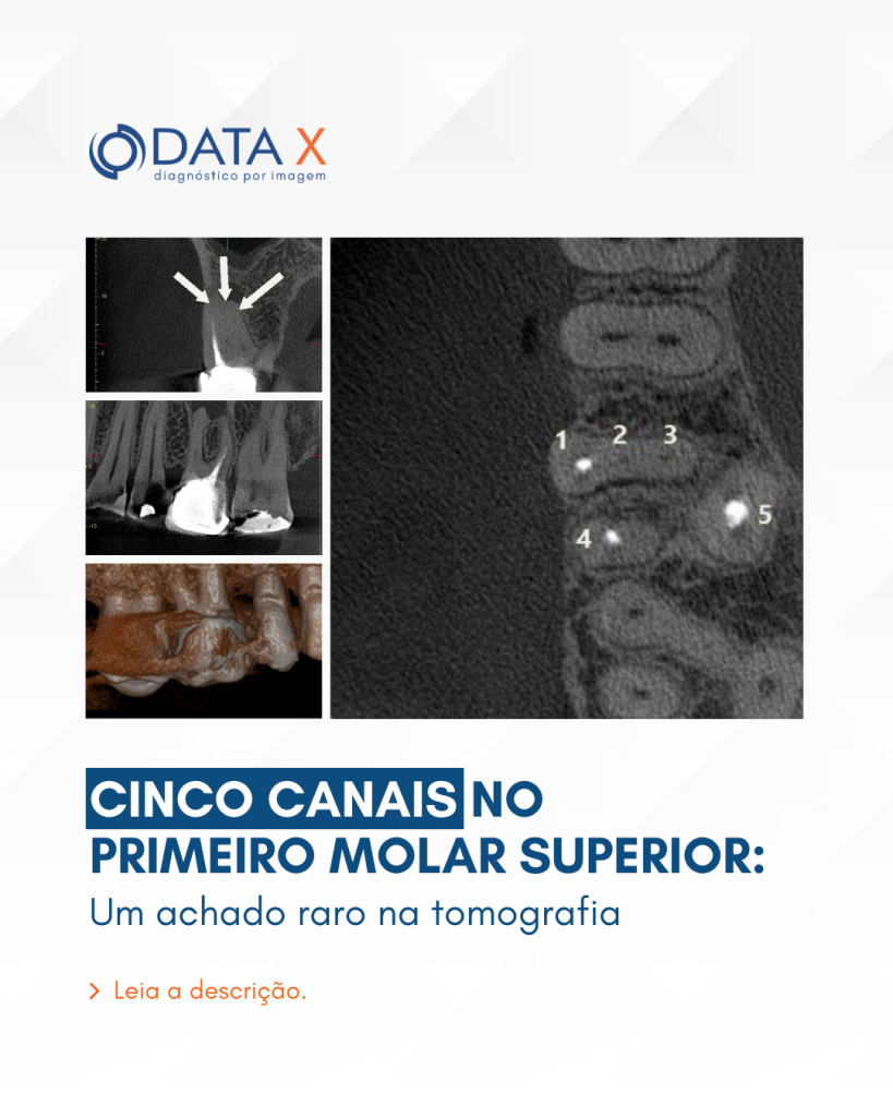 cinco-canais-no-primeiro-molar-superior