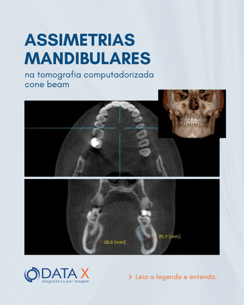 assimetrias-mandibulares-na-tomografia